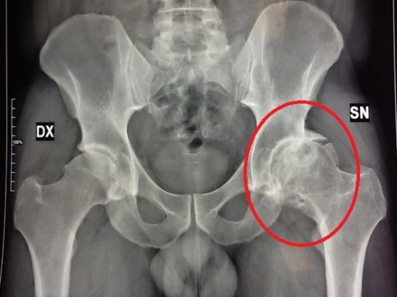 artrosi dell'anca